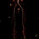 Occlusion of iliac artery, collateral blood flow: CT - Computed tomography